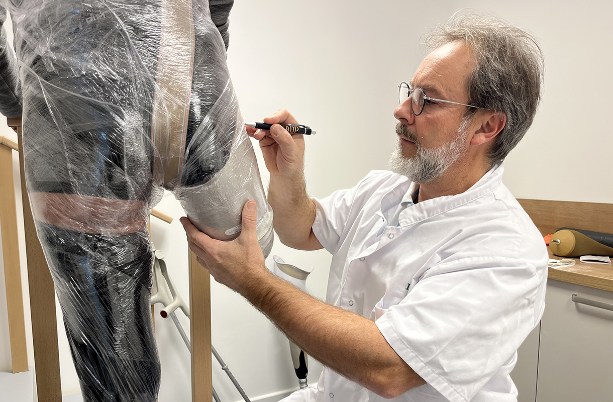 AOP - Moulage du moignon à la cuisse pour prothèse de jambe