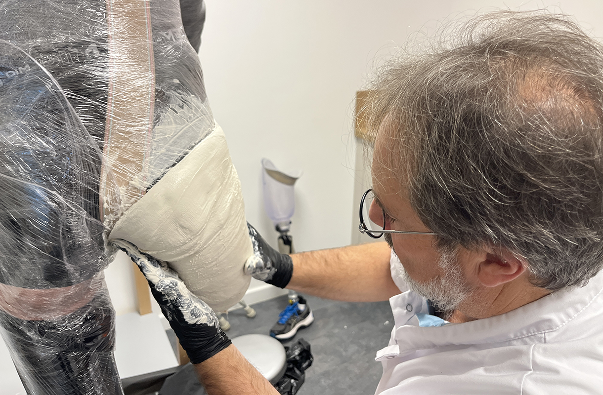 AOP - Moulage du moignon à la cuisse pour prothèse de jambe